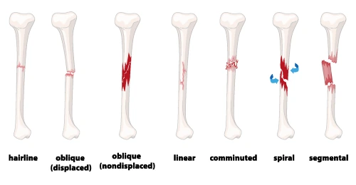 displaced-vs-non-displaced-fractures