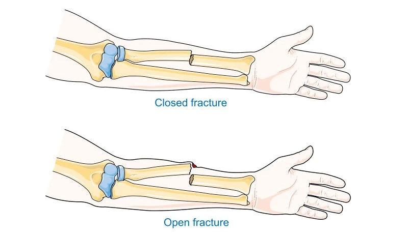 open-vs-closed-fractures